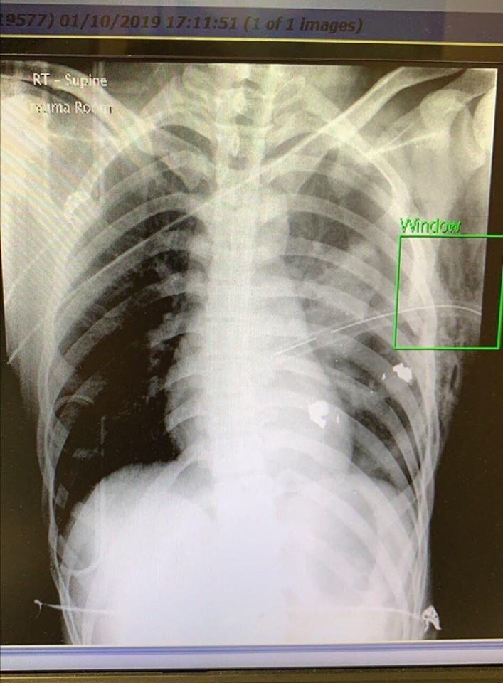 港媒報導指，傷者左肺中槍導致氣胸，子彈碎片距離心臟只有3公分。（圖擷取自TG＿寶寶Channel）