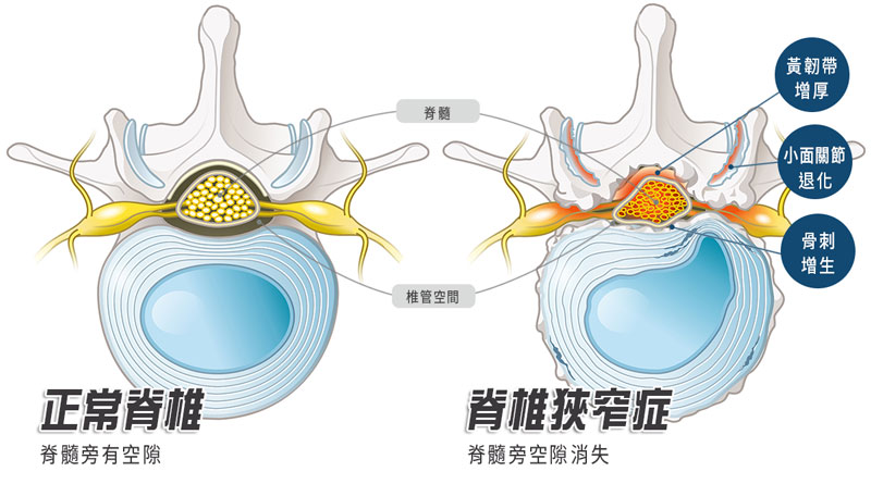 正常脊椎vs.狹窄脊椎。(圖/菁英診所提供)