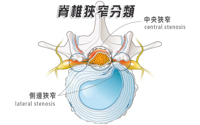 中央vs.側邊脊椎狹窄。(圖/菁英診所提供)