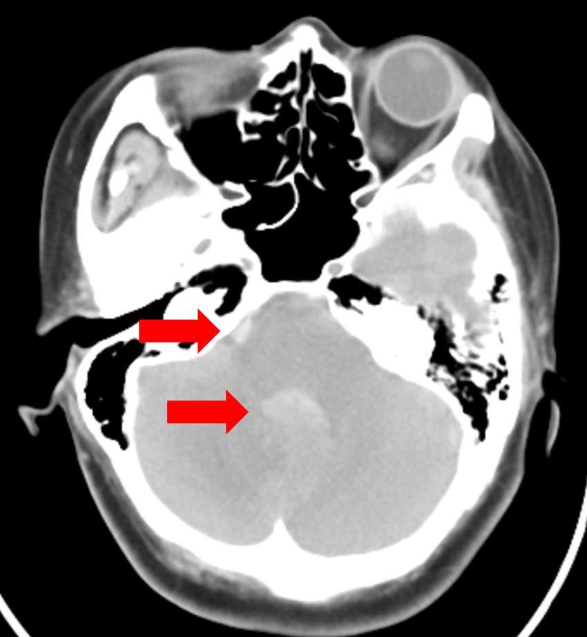 腦動脈瘤破裂引起的出血(箭頭處)。
