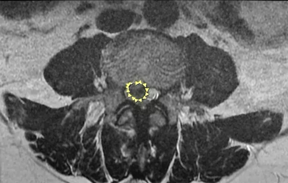 中醫大市醫微創脊椎中心日前救治一名急性椎間盤突出患者，藉由電腦導航脊椎內視鏡手術，僅花60分鐘解除患者疼痛。（示意圖，非當事人）(圖/中醫大市醫張建鈞醫師提供)