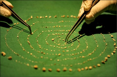中英對照讀新聞》Doctors extract 526 teeth from Indian boy 醫生從印度男孩體內取出526顆牙