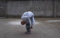 男子「臉貼膝蓋」30多年 歷經5次大手術終擺脫「摺疊人生」