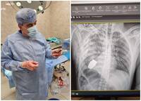 死裡逃生！ 烏軍士兵體內卡手榴彈 手術順利移除撿回一命