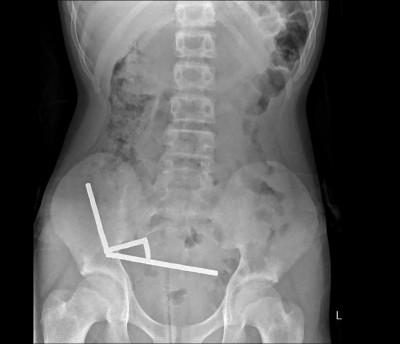 中英對照讀新聞》Surgeons remove up to 100 magnets from N. Zealand teen’s gut外科醫生從紐西蘭少年腸道中取出多達100枚磁鐵