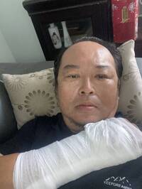 獨家》枋寮獨派丁勇智深夜遭伏擊 右手骨折、眼鏡碎裂