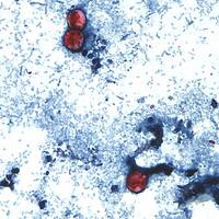 全美31州現寄生蟲感染 密西根暴增逾2600例