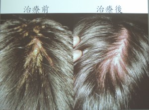 乾癬病天冷好發醫師建議保濕 地方 自由時報電子報