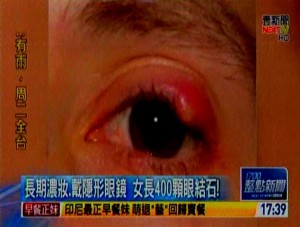 長戴隱形眼鏡 女子眼結石達400顆