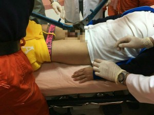 陽具環「助性」不成反困鳥  男子哀號跑醫院
