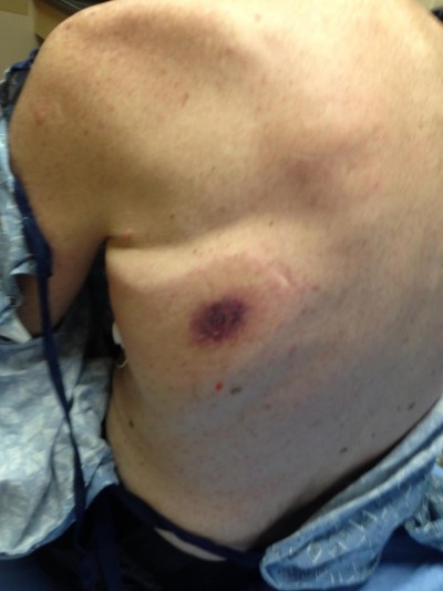 差點完 蛋 男下面癢猛抓 佛尼爾氏壞疽 上身 生活 自由時報電子報