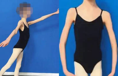 瘦成皮包骨！17歲芭蕾少女僅27kg 父母極端保護被判刑