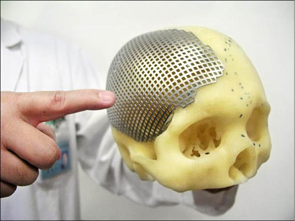 數位影像 塑形鈦能成功重建凹陷的顱骨 即時新聞 自由健康網