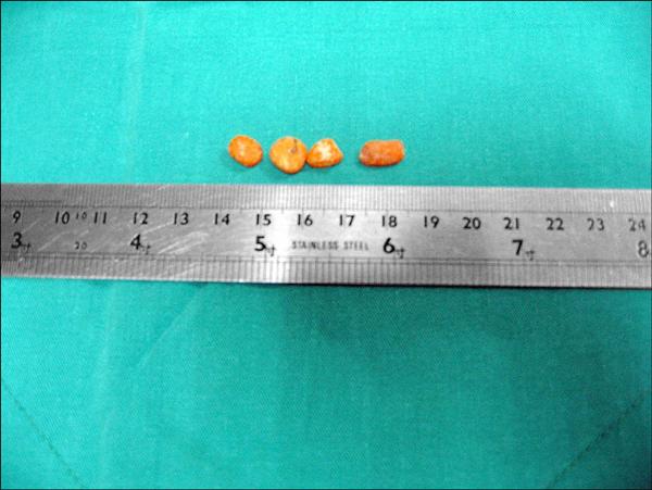 醫生用膀胱內視鏡取出林先生體內的塑膠粒，其大小、形狀不一。（記者李容萍攝）