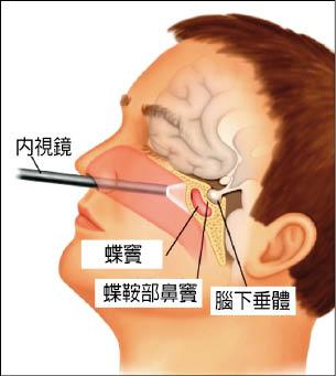 鼻水流不停竟是腦脊髓液外漏 即時新聞 自由健康網