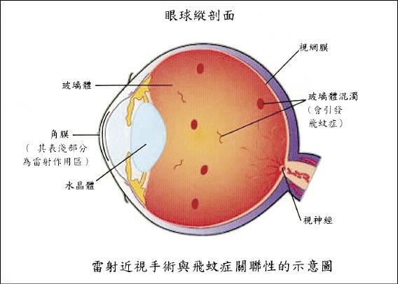 雷射近視飛蚊症與手術無關 即時新聞 自由健康網