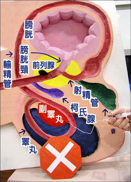 結婚3年不孕 妻輸卵管阻塞夫沒有輸精管 即時新聞 自由健康網