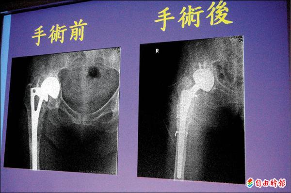 人工關節沒保養險些磨穿骨盆 即時新聞 自由健康網