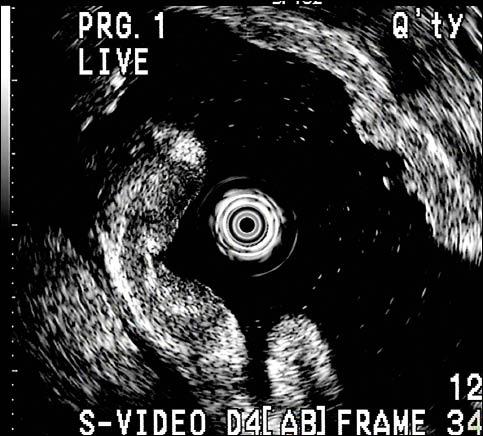 內視鏡超音波透視腸胃道腫瘤 即時新聞 自由健康網