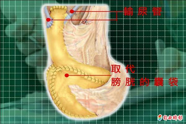 小腸重建膀胱癌友免掛尿袋 即時新聞 自由健康網