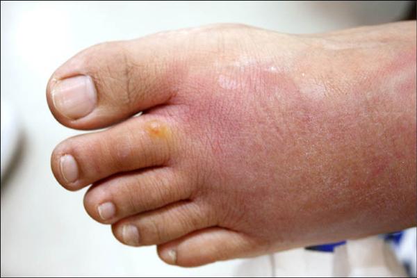 螞蟻咬一口男子抓成蜂窩性組織炎 即時新聞 自由健康網