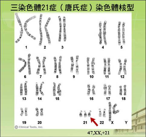 母血胎兒基因篩檢可測唐氏症 即時新聞 自由健康網