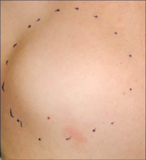 背長脂肪瘤病理檢查判好惡 即時新聞 自由健康網