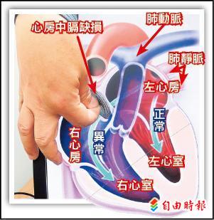 心房中膈缺損栓塞補洞救回健康 即時新聞 自由健康網