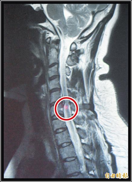 肩頸痠痛久不癒小心頸椎長骨刺 即時新聞 自由健康網