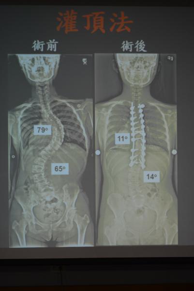 S型脊椎側彎醫院推灌頂法治療 生活 自由時報電子報