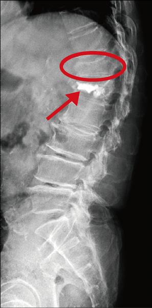 脊椎壓迫性骨折治療骨鬆才是根本 即時新聞 自由健康網