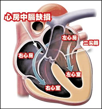 心房中膈缺損 生長遲緩童開心長大 即時新聞 自由健康網