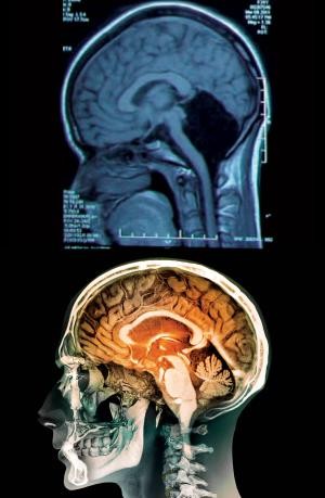 女子經電腦斷層掃瞄後，發現竟然沒有小腦。（圖片擷自New Scientist）