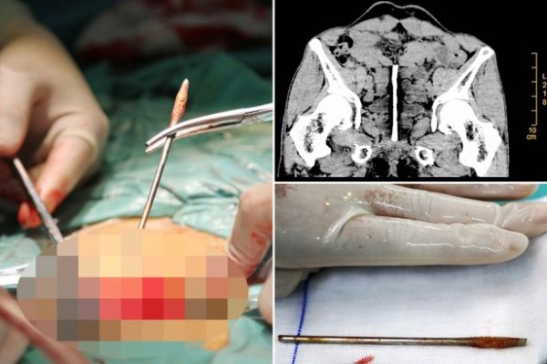 中國一名男子在生殖器中植入鐵釘，幸好及時取出，才沒有危及生命。（圖擷取自鏡報）