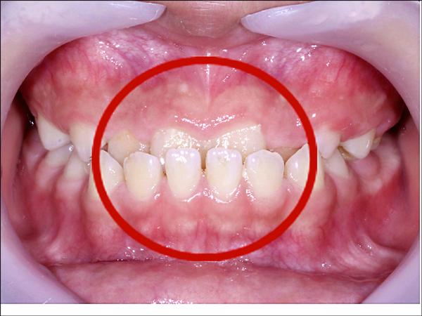 牙齒咬合不正需要矯正嗎 即時新聞 自由健康網