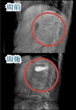 脊椎注射骨水泥搶救骨鬆站不直 即時新聞 自由健康網