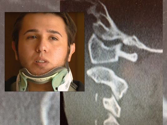 腦骨 脊椎完全分離美男奇蹟生還 國際 自由時報電子報
