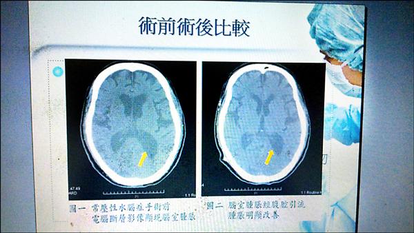 水腦症 併發失智 腰椎腹腔引流術 解憂 即時新聞 自由健康網