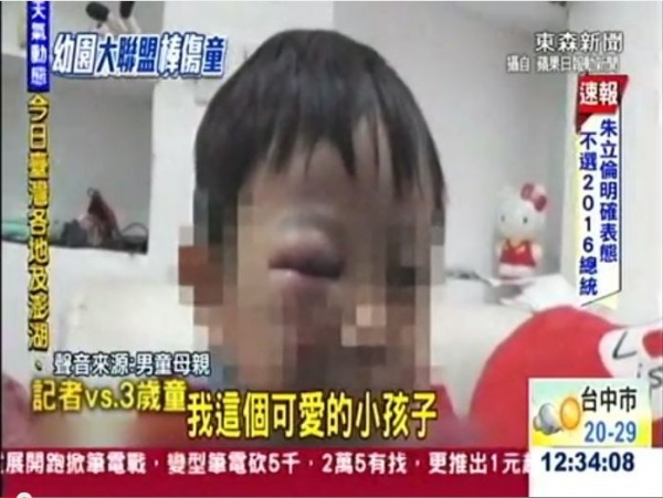 新北市幼稚園因老師疏忽，不小心把球棒揮擊到男童臉上，讓3歲男童眼睛被打到紅腫瘀血，校方事後坦承疏失。（圖擷取自東森新聞）