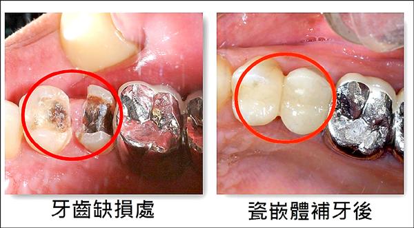 牙齒蛀很大嵌體比填補耐用 即時新聞 自由健康網