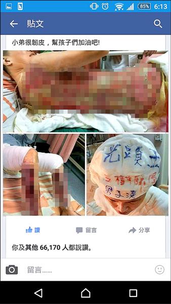 網友張字文貼出自己嚴重灼傷的照片。（擷取自臉書）