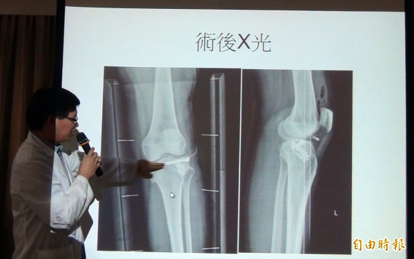 婦人犁田摔傷膝蓋手術3個月可以走路了 生活 自由時報電子報