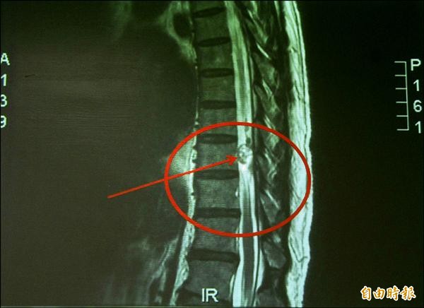 箭頭所指的就是神經腔內長的腫瘤。（記者陳鳳麗攝）