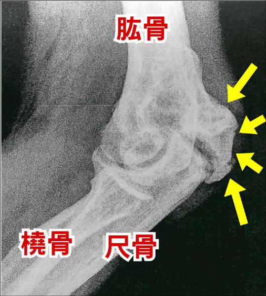 關節復健更僵硬異位性骨化症作怪 即時新聞 自由健康網