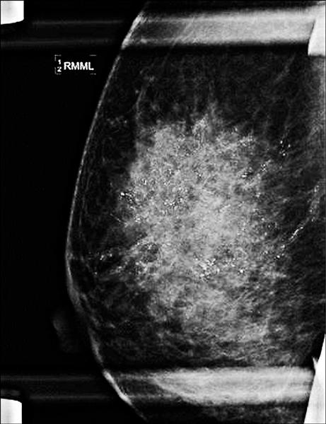 乳房鈣化 7種良惡性原因都可能造成鈣化 預防乳癌x光攝影5特質可分辨 早安健康