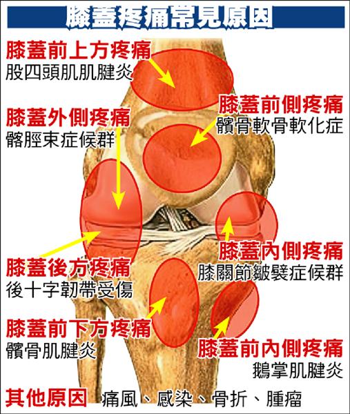 膝蓋疼痛病因多不見得退化性關節炎 即時新聞 自由健康網