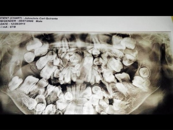 奇蘭德有約莫300顆牙齒。（圖片擷取自《ABS-CBN NEWS》）