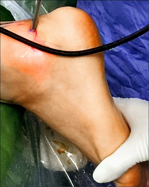 腳踝扭傷慢性疼痛 足踝關節鏡 手術改善 即時新聞 自由健康網