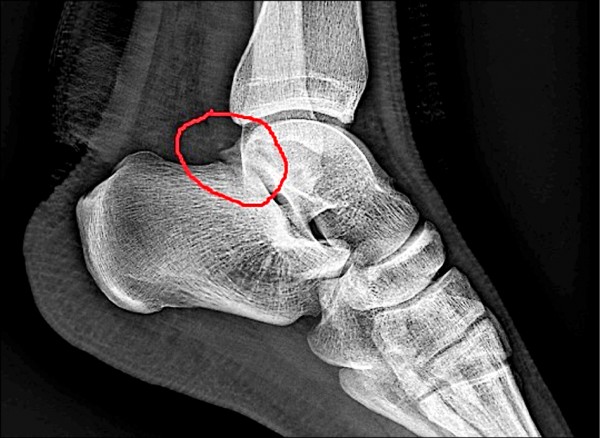 腳踝扭傷慢性疼痛 足踝關節鏡 手術改善 即時新聞 自由健康網