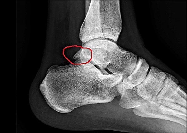 腳踝扭傷慢性疼痛 足踝關節鏡 手術改善 即時新聞 自由健康網